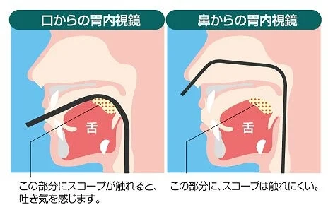 鼻内視鏡検査のメリット